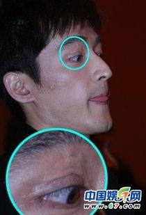 明星疤痕是怎么弄掉的,揭秘明星肌肤无瑕的秘密